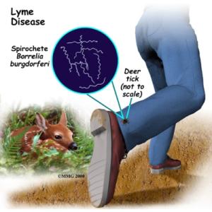 lyme-disease
